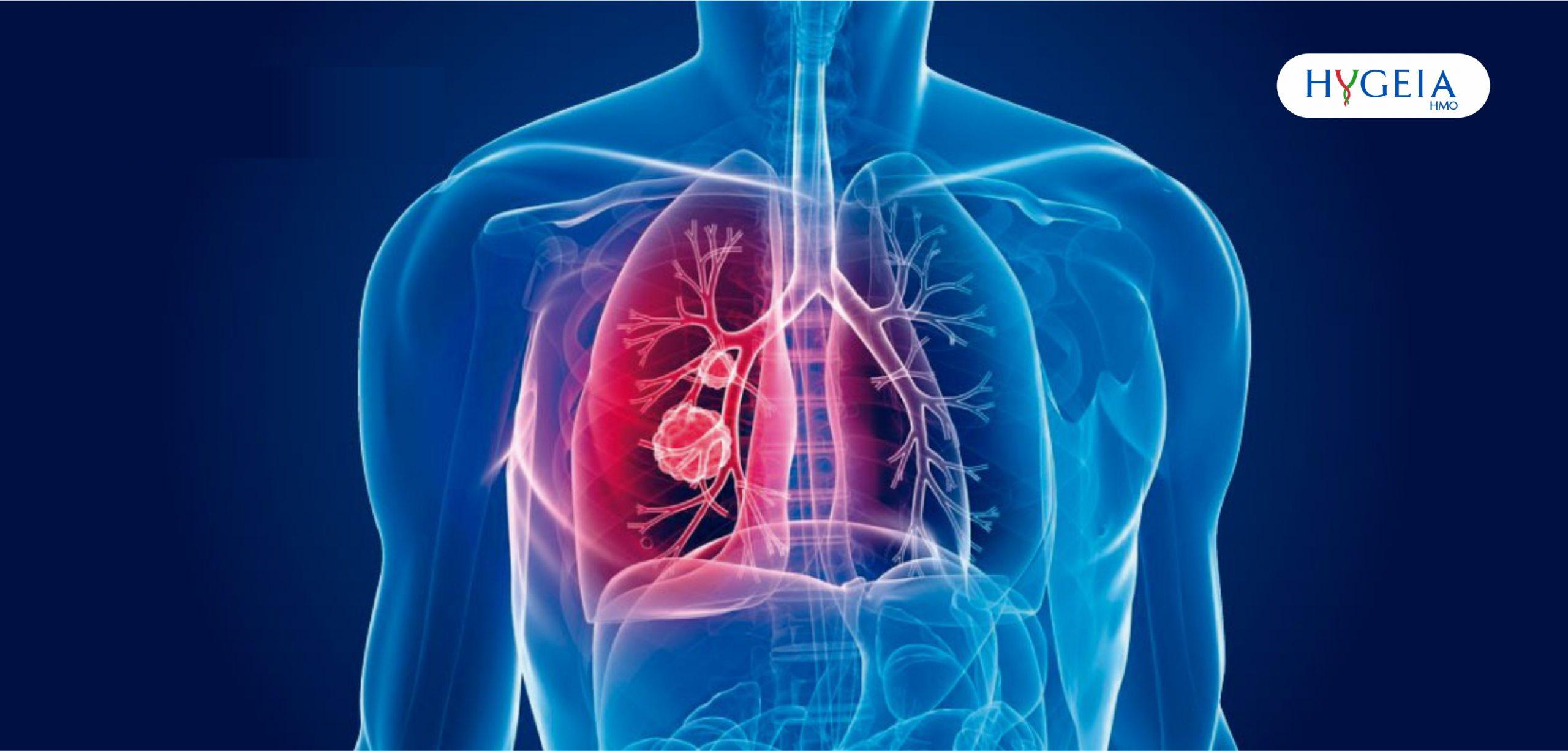 Neumonía, sida y tuberculosis
